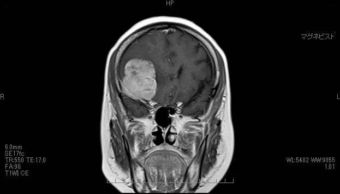 脳腫瘍術前②